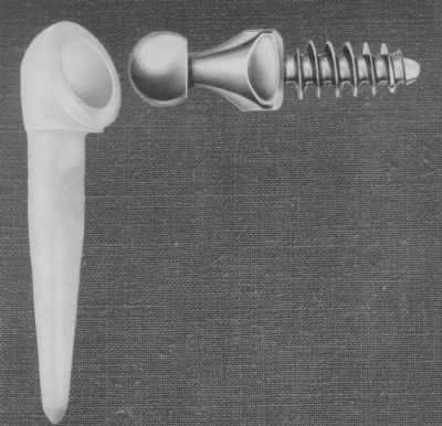 Shoulder, Total, Reverse:  Kessel (Implant 373)